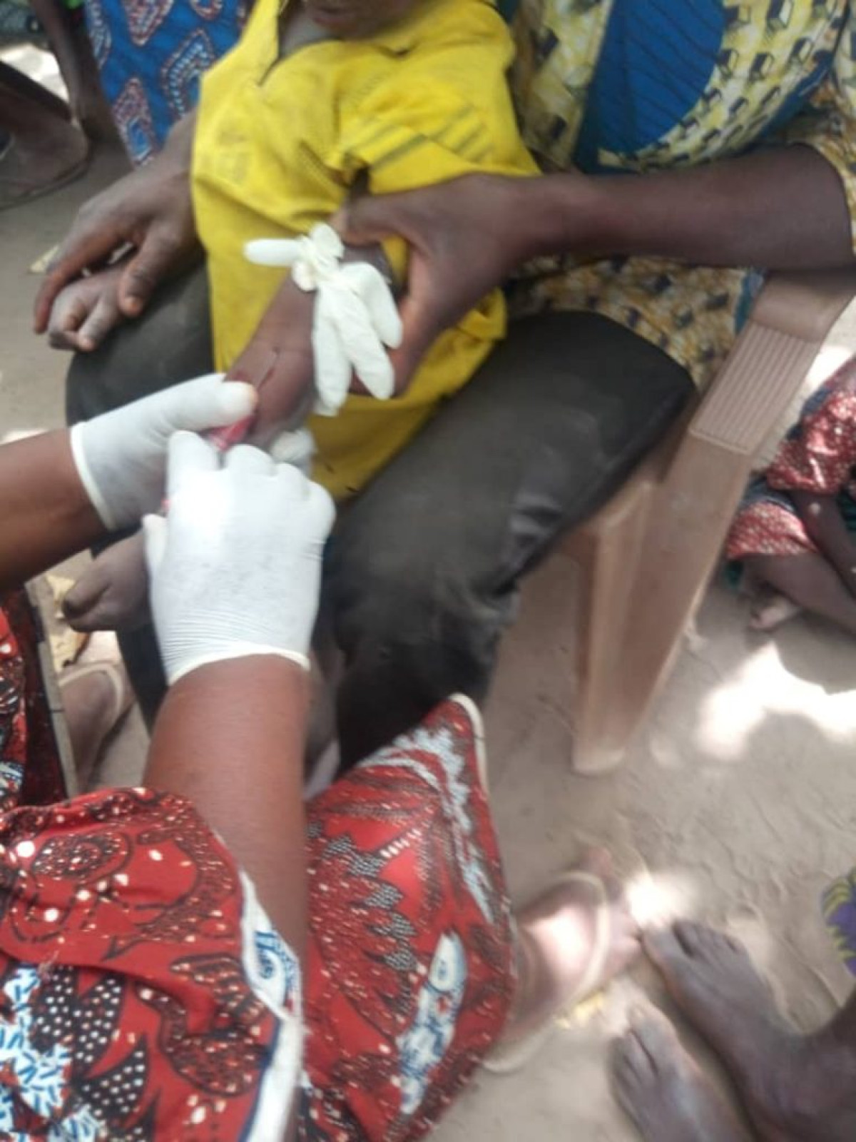 TCHAOUROU/DES CAS DE VIRUS DE VARICELE ET DE ROUGEOLE : Plusieurs enfants contaminés