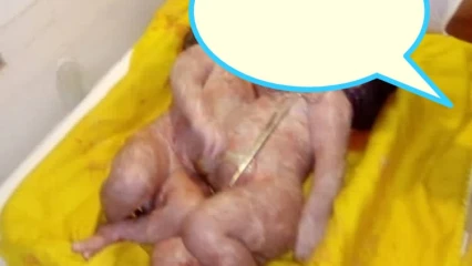 BENIN/ ACCOUCHEMENT DE BEBE SIAMOIS: Le père lance un Sos au gouvernement  ( Lire sa lettre ouverte au ministre des affaires sociales et de la microfinance)