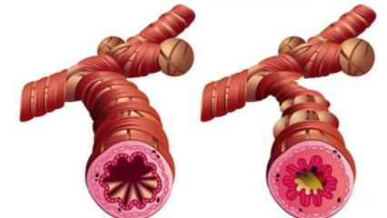 SANTE : Tout sur l&rsquo;Asthme