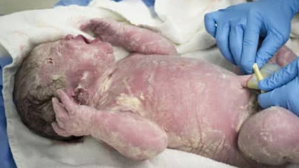 SANTE : Vernix caseosa, un liquide protecteur du nouveau-né