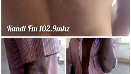 FAIT DIVERS À KANDI : Un censeur se fait mordre au dos par l’épouse d’un ancien vacataire