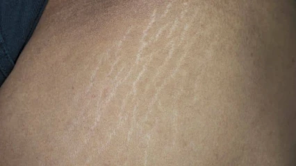 BIEN-ÊTRE CORPOREL : Ce qu’il faut savoir sur les vergetures