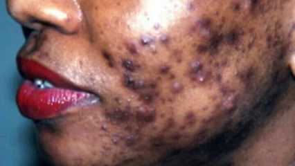 DEPIGMENTATION : Un phénomène à la peau  dure