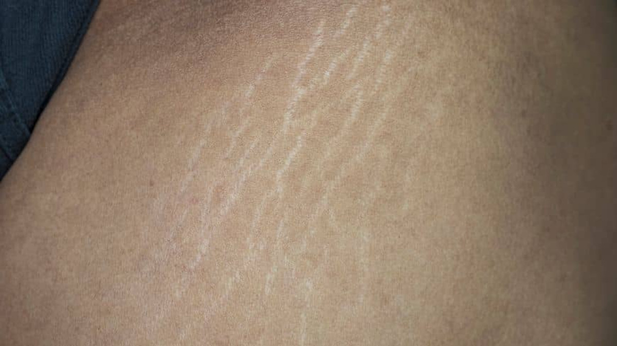 BIEN-ÊTRE CORPOREL : Ce qu&rsquo;il faut savoir sur les vergetures