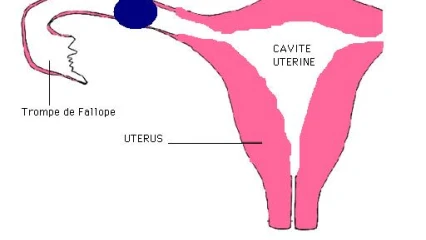 GROSSESSE EXTRA-UTERINE : Un phénomène méconnu, cause de nombreuses mortalités maternelles