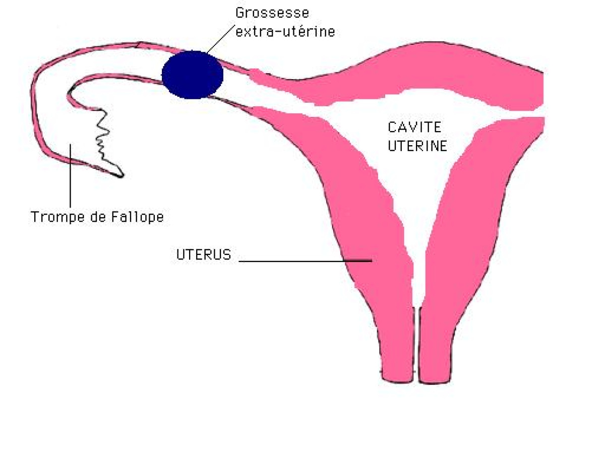 GROSSESSE EXTRA-UTERINE : Un phénomène méconnu, cause de nombreuses mortalités maternelles