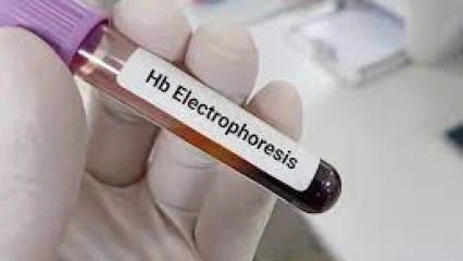SANTÉ : La nécessité du test d’électrophorèse avant le mariage