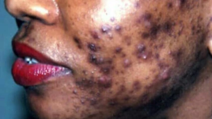 DEPIGMENTATION : Un phénomène à la peau  dure