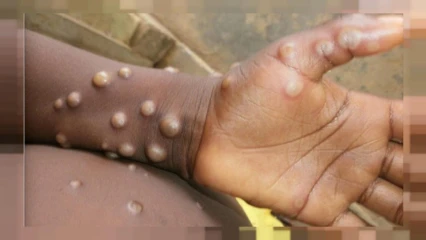 VARIOLE DU SINGE : Ce qu’il faut savoir de cette nouvelle maladie qui sévit au Bénin