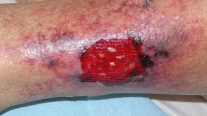 Au profit des personnes souffrant de plaies chroniques au Bénin: Des consultations gratuites lancées sur tout le territoire