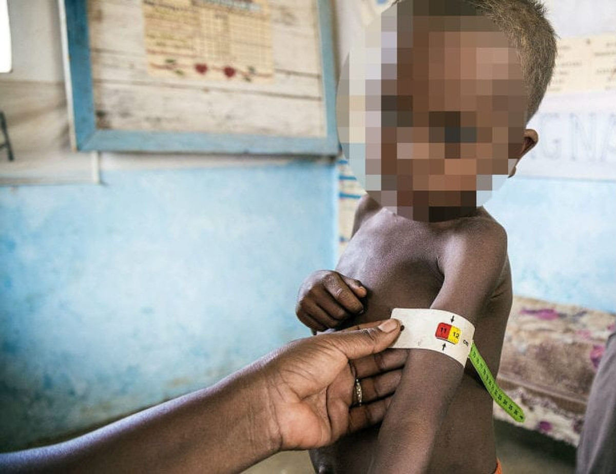 MALNUTRITION : Une maladie méconnue avec de graves conséquences sur la santé
