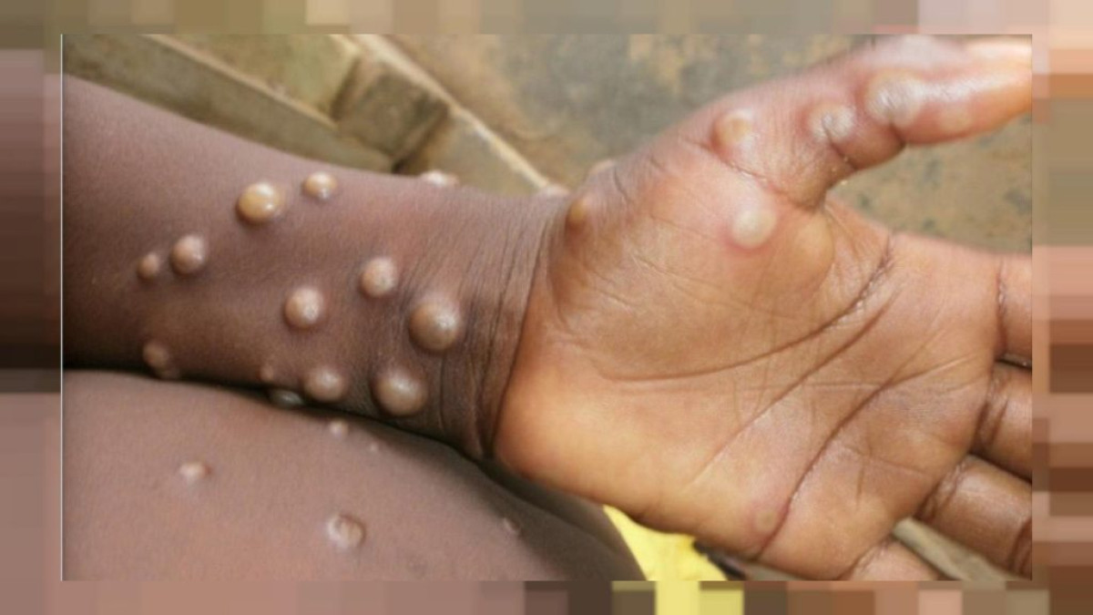 VARIOLE DU SINGE : Ce qu&rsquo;il faut savoir de cette nouvelle maladie qui sévit au Bénin