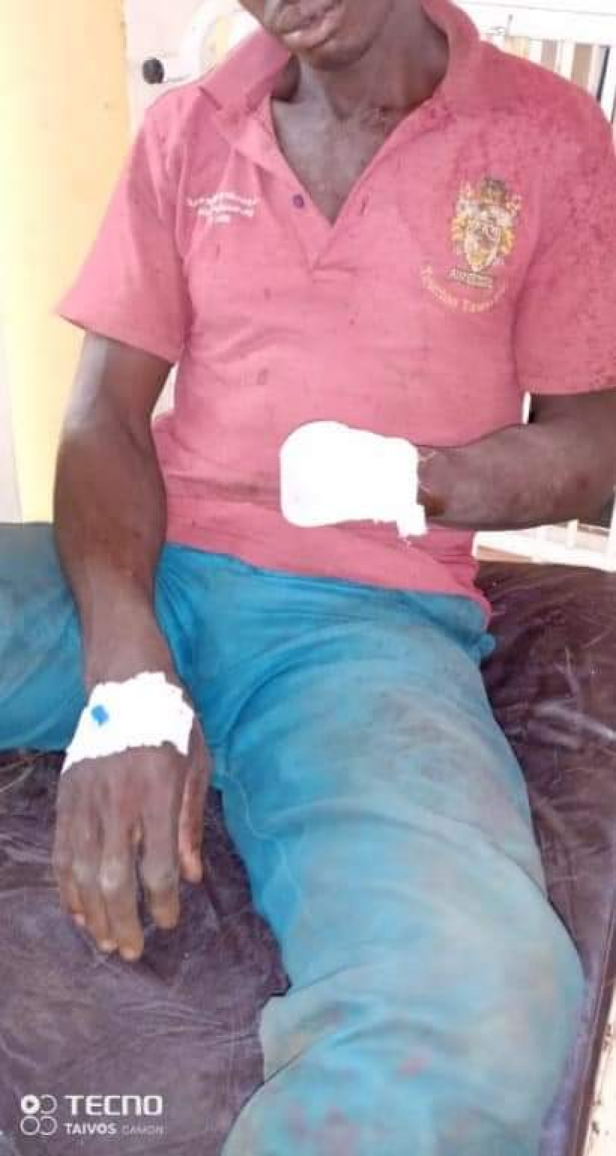 CONFLIT ENTRE AGRICULTEURS ET ELEVEURS A KALALE : Un bouvier ampute le poignet d’un cultivateur