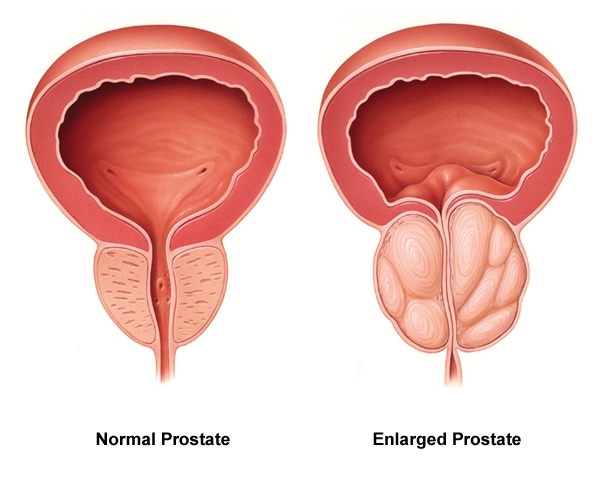 CANCER DE LA PROSTATE : Avoir une vingtaine de rapports sexuels par mois, permet de se protéger du cancer de la prostate, selon Dr Fidèle Zinsou