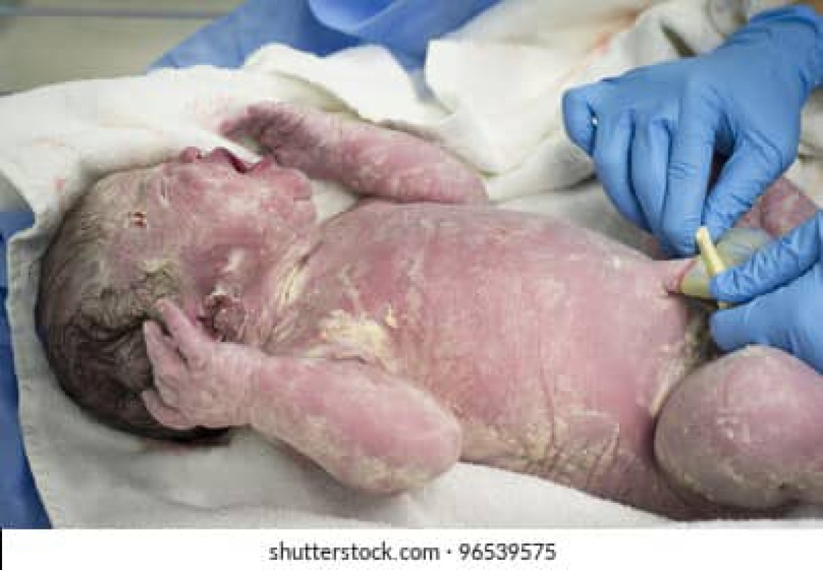 SANTE : Vernix caseosa, un liquide protecteur du nouveau-né