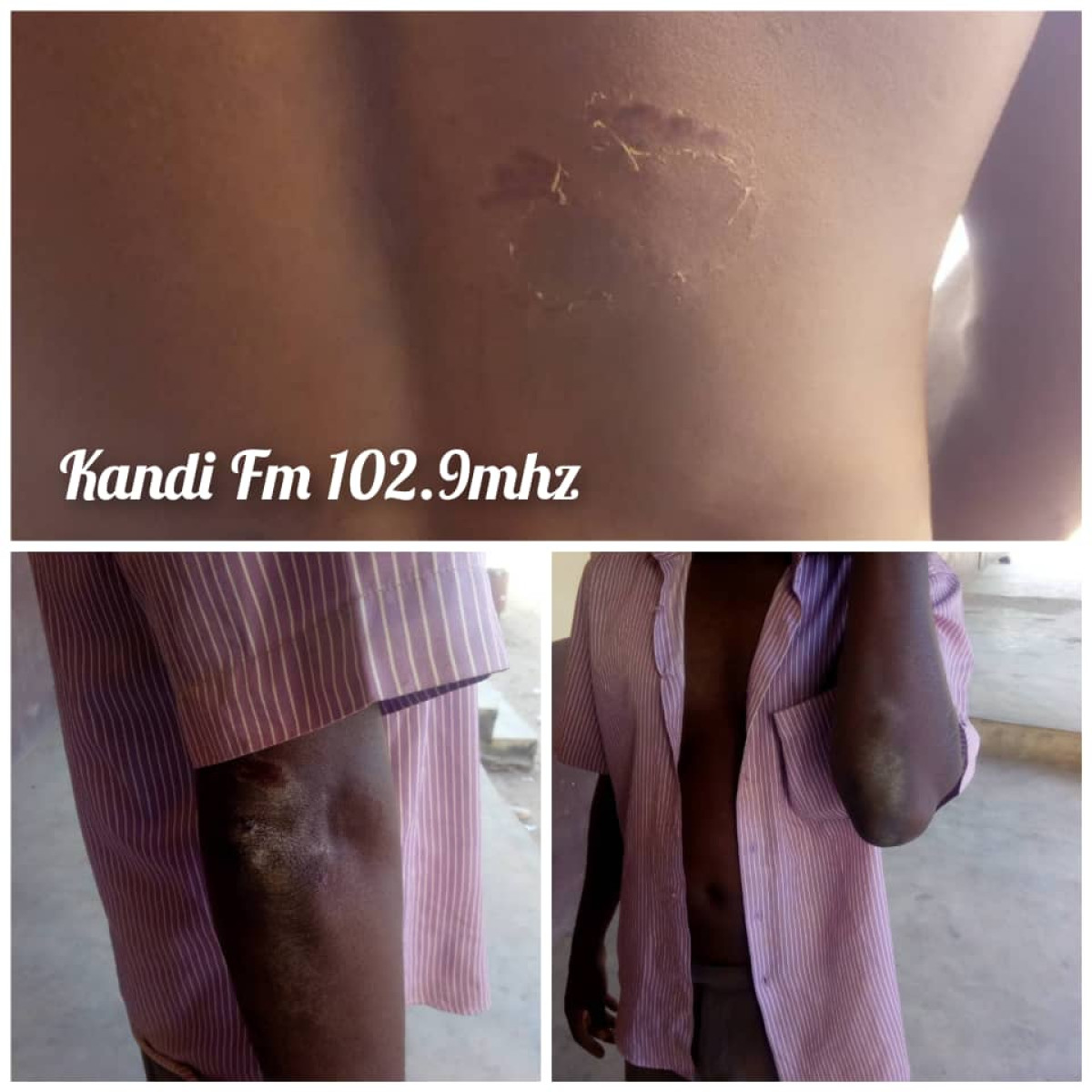 FAIT DIVERS À KANDI : Un censeur se fait mordre au dos par l&rsquo;épouse d&rsquo;un ancien vacataire